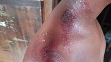 ten-year-old-boy-suffered-sunburn