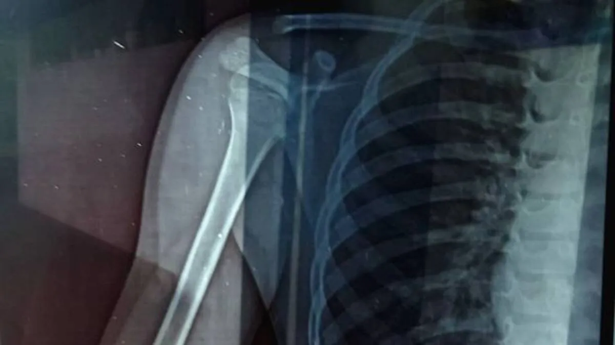 x-ray