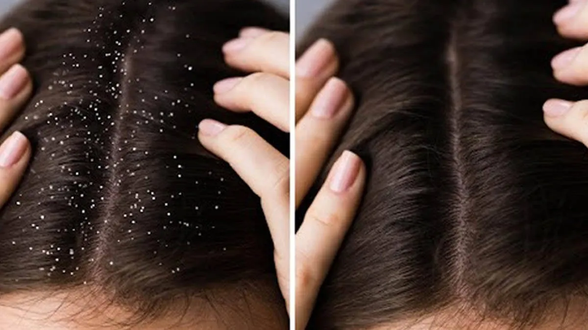 dandruff-