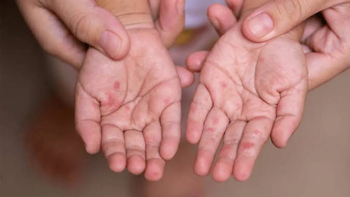 hand-foot-mouth-disease