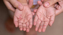 hand-foot-mouth-disease