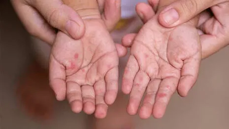 hand-foot-mouth-disease.1.4064732