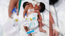 conjoined-twin-with-two-heads-one-torso-dies-week-after-birth-at-odisha-hospital