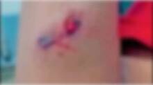 injuries
