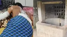 burns
